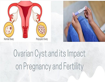 Ovarian Cyst and its Impact on Pregnancy and Fertility