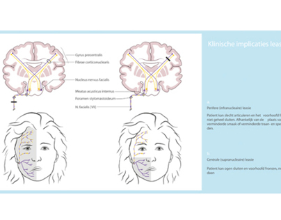 Illustrating the facial nerve