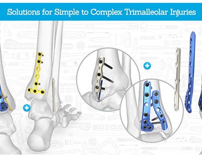 Trimalleolar Fracture Campaign