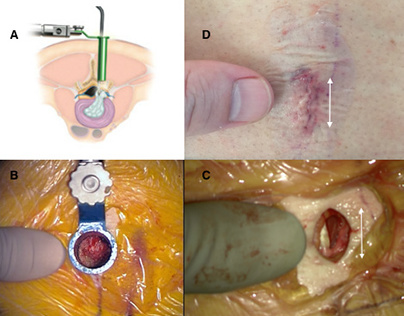 Minimally Invasive Lumbar Discectomy