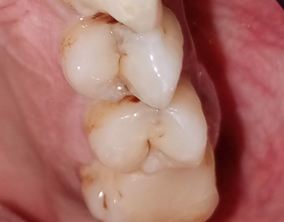 RCT for tooth no.24 with post and core build up