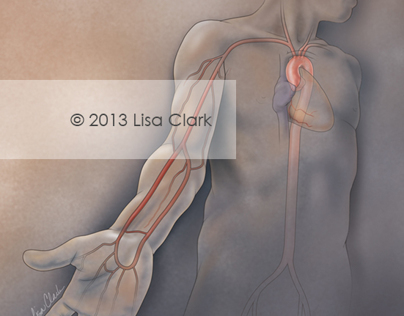 Radial Artery Access for PCI