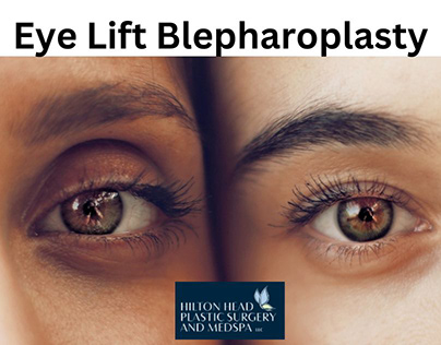 The Best Treatment of Eye Lift Blepharoplasty