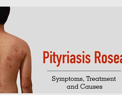 Pityriasis Rosea: Symptoms, Causes and Natural Relief