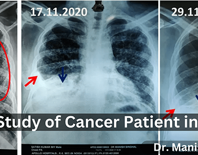 Case Study of Cancer Patient in India
