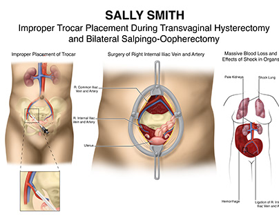 Sally Smith: Improper Trocar Placement