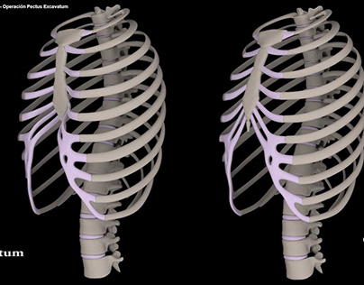 Pectus Excavatum Surgery (3D Visualization)