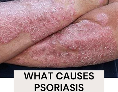 what causes psoriasis
