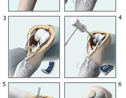 Surgical Illustration 2 - Oxford Uni-Compartmental Knee