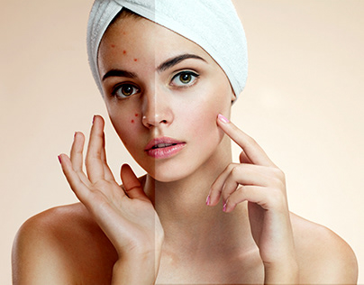 Blemishes with Acne Cleaning .