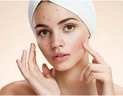Why Is Pimples Treatment Important?