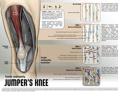 Jumper's Knee pathophysiology