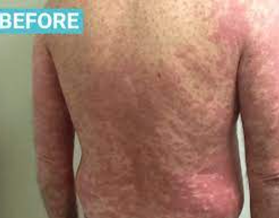 phototherapy for psoriasis Scottsdale