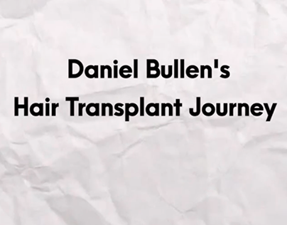 Daniel Bullen's Hair Transplant Journey
