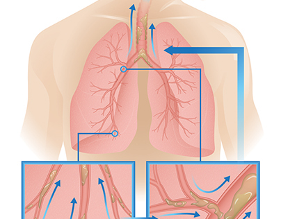 Airway Clearing Process