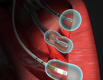Heart Catheters