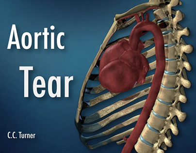 Aortic Tear 