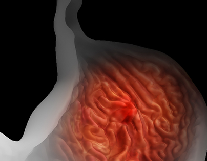 3D Illustration of a Stomach Ulcer