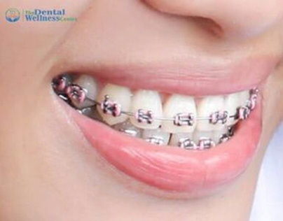 Unlock Your Perfect Smile : Orthodontic Treatment