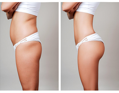 Brazilian Butt lift Treatment by Dr. Claudine Roura