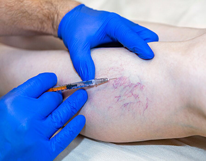 Looking for Sclerotherapy Treatment in Appleton, WI?