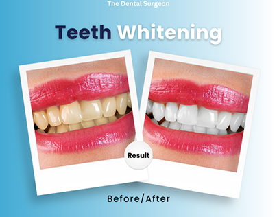 A Brighter Smile with Teeth Whitening Treatment