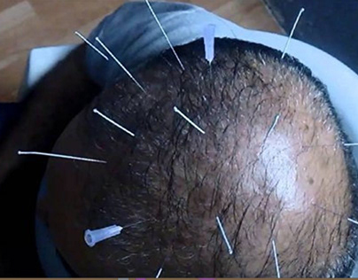 Acupuncture for Hair Loss
