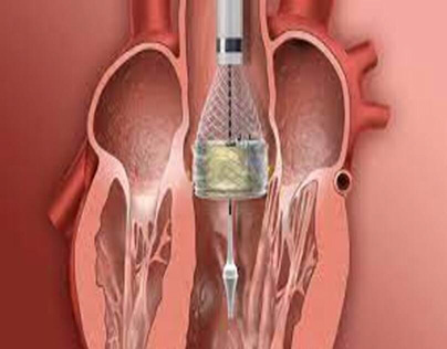 What Are the Success Rates of TAVR Surgery in India?