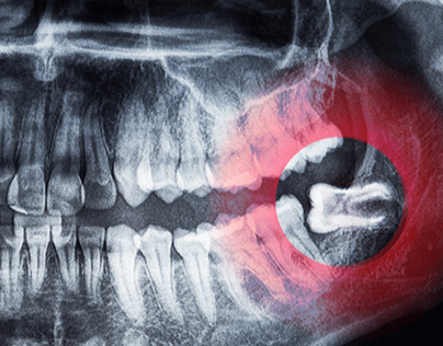What’s A Wisdom Tooth, And What Are The Symptoms?