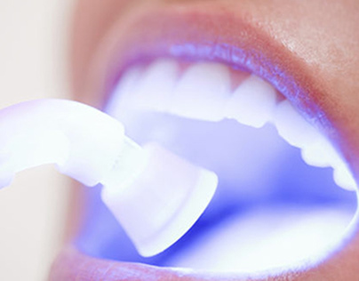 Laser Teeth Whiting Dentist in Chandigarh