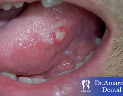 Tongue ulcer – Causes, Symptoms & Treatment