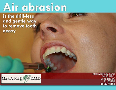 Air Abrasion Juno Beach - Best Abrasion Dentist FL