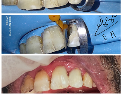 Fiber post and composite core tooth no.22