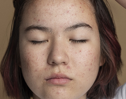 Fight Acne, Effective Beauty Practices