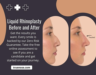 Liquid Rhinoplasty Before and After
