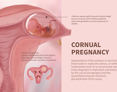 Cornual Pregnancy