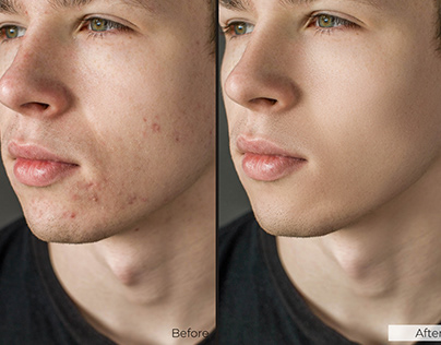 Face retouching: remove acne, spots, wrinkles