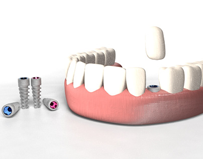 Implantes Dentales Render