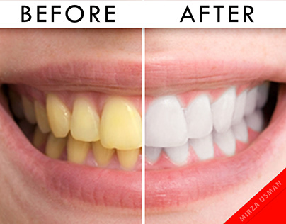 Teeth whiteness