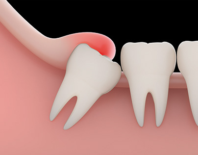 Wisdom Tooth Removal Dentist