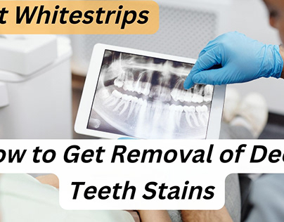 How to Get Removal of Deep Teeth Stains