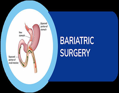 Choosing the Best Bariatric Surgeon in Punjab