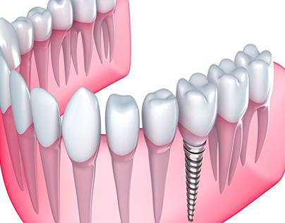 Dental Implants In Valdosta, GA | Perfect Smile