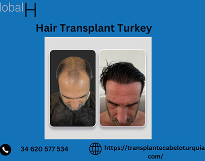 Transplante Capilar Turquia