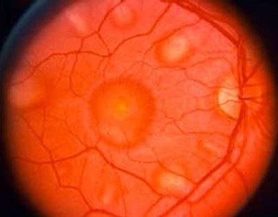 Juvenile macular dystrophy (JMD).