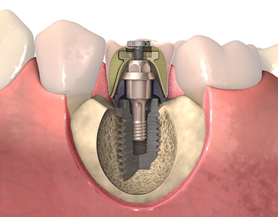 A Multi Unit Abutment For Implant Restorations