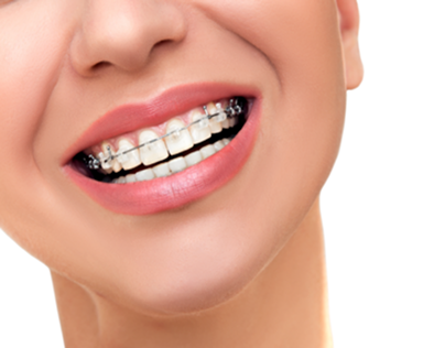 How Clear Braces Are the Key to a More Confident Smile