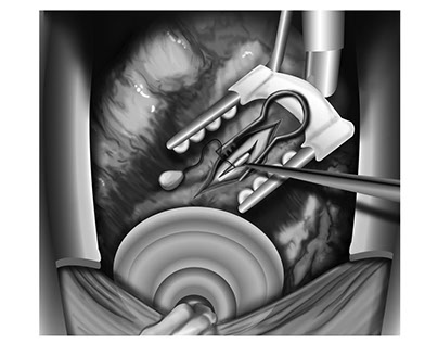 Surgical Illustration : Coronary Artery Bypass