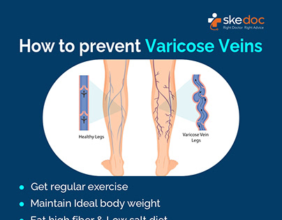 Symptoms of Varicose veins