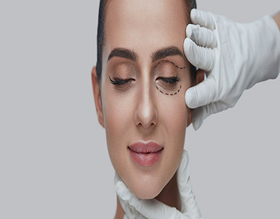 Blepharoplasty | EyeLid Surgery by Dr. Sachin Rajpal